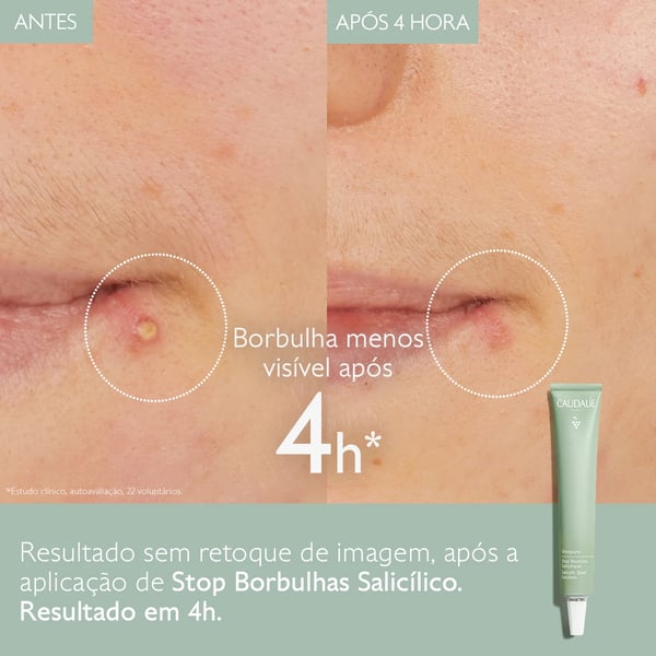 2-vinopure-stop-boutons-before-after-caudalie-pt.webp